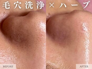 レヴェリー 心斎橋店(REVERIE)/‐ ハーブピーリングB&A ‐