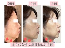 アドレル(Adorer)の雰囲気（加齢に伴う小顔たるみケアが得意です★見える結果重視のサロン！）