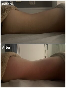 エニ 恵比寿(eni)/お腹腰回りのビフォーアフター