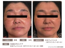 グラシーズ(Glasses)/白玉フェイシャル・スノーピール