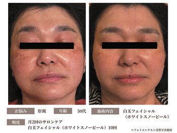 グラシーズ(Glasses)/白玉フェイシャル・スノーピール