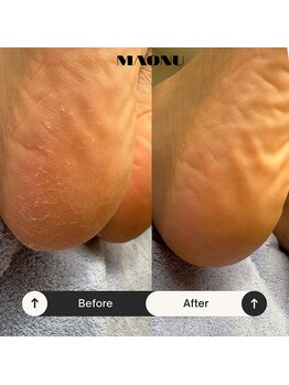 マオヌー(MAONU)/韓国式足裏角質ケア　症例写真