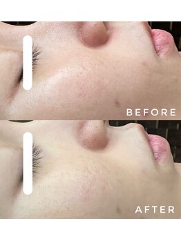 カウニス るる(kaunis)/【ララピール】Before After