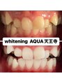アクア 天王寺店(AQUA)&nbsp;セルフホワイトニング/大阪/天王寺/小顔/ホワイトニング/美白