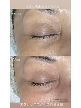 美顔秘密基地 新宮/お顔に弾力エクシリス！