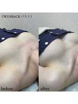 エステティック レイビス 八戸店(RAYVIS)/驚き変化！マシュマロ３Dバスト