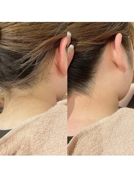 シアージュ(ciage.)/うなじ全体ワックス脱毛