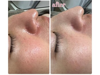 シミ・たるみケア専門店Labo荒尾大牟田【光フェイシャル/プラズマ/毛穴洗浄/韓国WAX】/毛穴洗浄/ハイドラフェイシャル