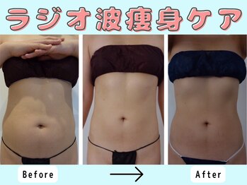 プレフィール(PLEAFEEL)/痩身☆ぽっこりお腹症例