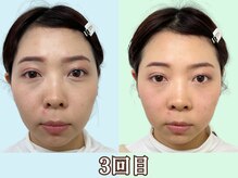 ナチュラルパーフェクトフェイス 新宿/歪みが改善／新宿造顔小顔