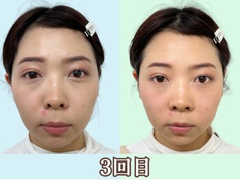 ナチュラルパーフェクトフェイス 新宿/歪みが改善／新宿造顔小顔