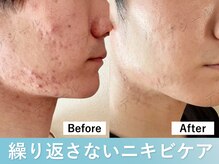 デジール/4月限定 繰り返しできるニキビに