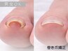 【新規】歩くのが楽に♪爪のカーブを整える巻き爪矯正|親指1本