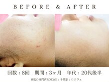 ロエヴェ(ROEWE)/ニキビ改善・毛穴ケア・肌質改善