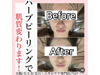 アルムダアクア 天王寺店(Aleumda AQUA)/ハーブピーリング/大阪/天王寺