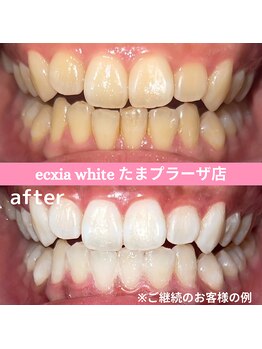 エクシアホワイトニング たまプラーザ店/ビフォーアフター
