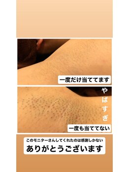 ケアアネラ(KeaAnela)/１度の脱毛で効果がわかる！