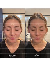 フフラ KANコルギセラピー山梨本店(fufla)/【頭皮筋膜リフト】