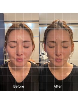 フフラ KANコルギセラピー山梨本店(fufla)/【頭皮筋膜リフト】