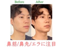 ラプリ 福岡天神店(Raplit)/隆鼻+輪郭・小顔矯正 美鼻/小顔