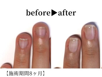 リング ザ ベル(ring the bell)/深爪スタンダードコース¥11,000