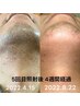 【メンズニキビケア 顔脱毛(全顔）＋毛穴洗浄吸引】肌荒れ改善毛穴レスな肌へ