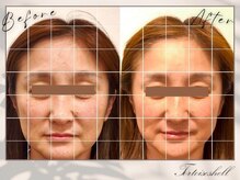 トーティシェル(tortoise shell)/どんどん若々しく！