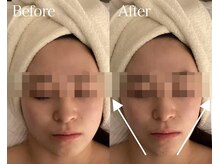 ライム 名古屋(LIME)/ハーブピーリング｜背中ニキビ