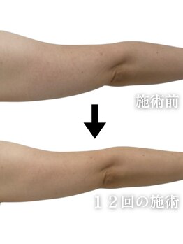 スリムビューティー 立川店/脂肪分解二の腕スッキリ美腕へ