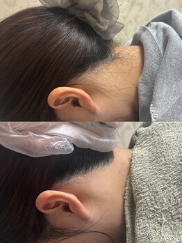 シルビー(CILBE)/うなじ脱毛