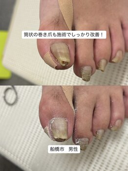 巻き爪じゅん 千葉駅前店/巻き爪の強い痛みと変形が改善