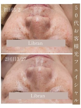リブラン(Libran)/目の下のハリ、シミ変化☆