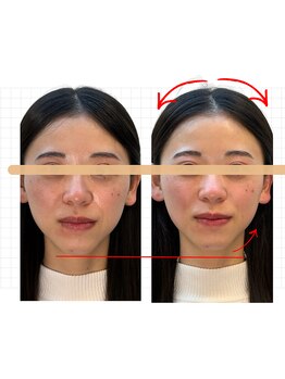 東麻布アマン(東麻布Aman)の写真/完全個室で美容鍼！小顔や小頭の魅力へ導く美容ケア。結果を大切にする保証で納得♪