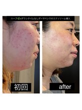 ユウェール(JUWEEL)/ニキビ徹底改善