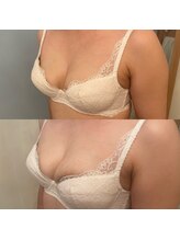 メゾン アンジュ(Maison Ange)/バストアップ症例／育乳／バスト