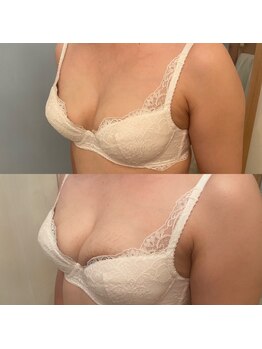 メゾン アンジュ(Maison Ange)/バストアップ症例/育乳/バスト