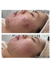 クリスタル(CRYSTAL)/OHLハーブピーリング