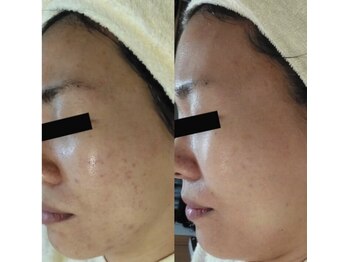 ホワイトアクア 梅田本店(WHITE AQUA)/ララピール/大阪/梅田/毛穴/小顔