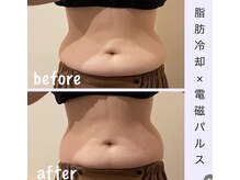 アールアンドエス(R&S)/脂肪冷却