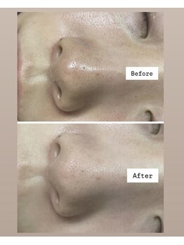 FJ/毛穴黒ずみ◆本来の肌へ