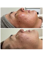 堺整骨院 小郡院/毛穴洗浄