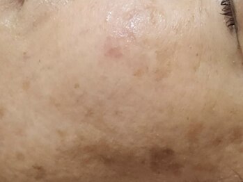 マプン(Mapun)の写真/年齢肌によるシミ、シワ、たるみなど。改善と予防のWケア！お肌のお悩みを徹底改善♪