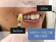 ホワイトニングカフェ 鷺沼店(WhiteningCafe)/◎歯のホワイトニング施術写真◎