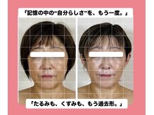 真美(Sinbi)の雰囲気（50代女性／施術3回でフェイスラインスッキリ！瞼が上がり目力UP）