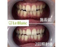 ルブラン 奈良店(Le Blanc)/たった2回でこんなにも白く！