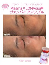 センシズ(Senses)/小ジワ・たるみ・くすみ改善