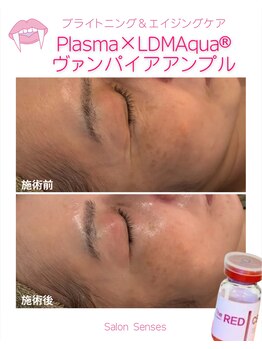 センシズ(Senses)/小ジワ・たるみ・くすみ改善