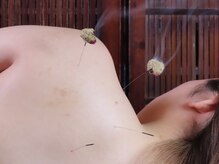 げんき接骨 鍼灸サロン/肩こりに灸頭鍼