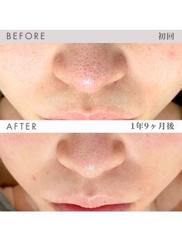 ビーミーバイライブリー(be+me by LIVELY)の写真/開き・たるみ毛穴に。マイクロニードル×幹細胞で内側からハリのあるなめらか肌へ