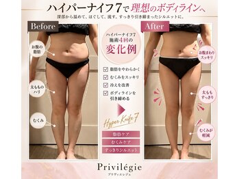 プリヴィエレジェ(privilegie)/ハイパーナイフ7 施術４回
